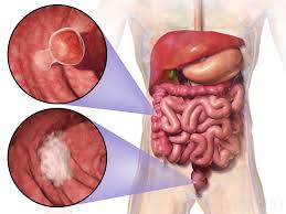 We have put together a list of common signs and symptoms of rectal cancer below. Colorectal Cancer Wikipedia