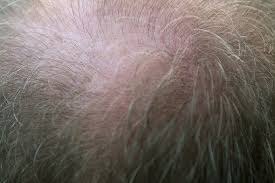It is generally accepted that in order to test positive, the drug in question must have been used 3 times or more within the window of the test. Does Pulled Out Hair Grow Back Trichstop Com