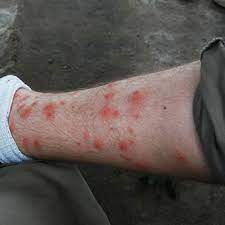 Do you get chigger bites when you mow your lawn or hike in a heavy vegetated area? Chiggers 484184 Ask Extension
