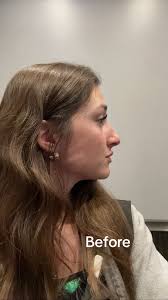 Alyssas Nose Before and After