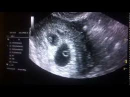 It depends on your situation. 6 Weeks Pregnant With Twins Ultrasound Symptoms And More Twinstuff