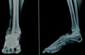Image result for Subtalar Dislocation