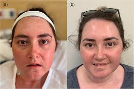 Bilateral facial neuritis associated with dabrafenib and trametinib after  failure of neoadjuvant immunotherapy for stage III melanoma