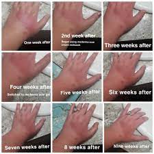 How long does it usually take for a burn to heal? A Different Type Of B A Nine Weeks Of Healing From 2nd And 3rd Degree Burns From Hot Coffee Routine In Comments Skincareaddiction