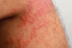 Image result for Atopic eczema atopic dermatitis
