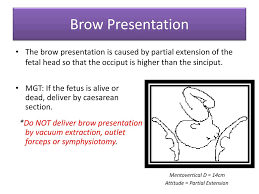 Image result for Brow Presentation