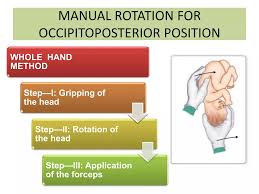 Image result for Manual Rotation in Occipitoposterior Presentation