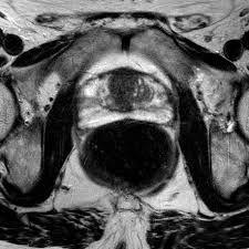 Get information about how to live well after prostate cancer treatment and make decisions about next steps. Prostate Cancer Transition Zone Radiology Case Radiopaedia Org