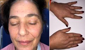 A, Spider‐like telangiectasia were mainly located