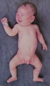 Image result for Floppy Infant