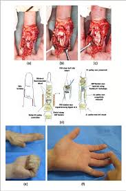 Tinsley abstract zone 1 flexor tendon injuries encompass several different types of repair techniques. Clinical Results Of Releasing The Entire A2 Pulley After Flexor Tendon Repair In Zone 2c Semantic Scholar
