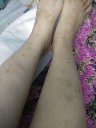 Prepare a mixture of baking soda and water (equal parts). These Are Some Mosquito Bite Scars Which Are Too Old And Have Been Formed By Scratching Them I Ve Used Some Creams And Medicines But No Effect Is Seen Please Help I Need