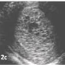 5e mois de grossesse semaine de grossesse 18 19 20 21 22. Pdf Apport De L Echographie En Urgence Dans La Prise En Charge Des Metrorragies Du Premier Trimestre De La Grossesse J Afr Imag Med 2010 3 3 187 196