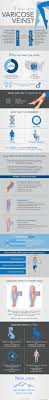 All Of Your Varicose Vein Questions Answered In One Simple