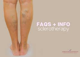 Sclerotherapy Faqs Important Information