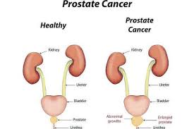 How would you know if you have prostate cancer? Light Therapy And Prostate Cancer What Do You Know About It