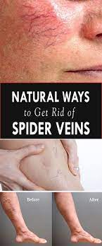 Pin By Maja Tatalovic On Spider Veins Spider Veins Get Rid Of Spider Veins Varicose Vein Remedy