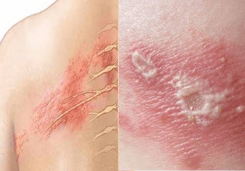 Đau sau zona thần kinh uống thuốc gì? | Vinmec