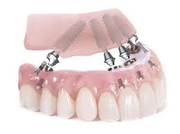 How much can i expect my treatment to cost? All On 4 Dental Implants How Do They Work And Are They For You