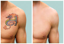 Item specifics tattoo pen type: Laser Tattoo Removal By Inkless