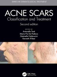Entdecke rezepte, einrichtungsideen, stilinterpretationen und andere ideen zum ausprobieren. Acne Scars Classification And Treatment Scar Inflammation