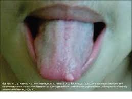 Image result for papillomavirus tongue)