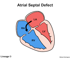 Image result for Atrial Septal Defect