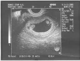 Symptoms which are pregnancy signs. Identical Vs Fraternal Explaining Your Twin Ultrasound Twins Ultrasound Ultrasound Pictures Baby Ultrasound Pictures