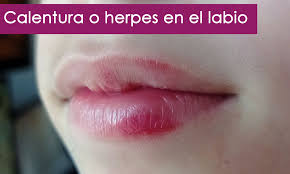 Por Que Me Salen Pequenos Puntos Blancos En Los Labios