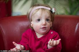 Franceschetti zwahlen klein syndrome ver síndrome de franceschetti … diccionario de oftalmología. Parents Of Baby With Treacher Collins Syndrome Defend Having Daughter Daily Mail Online