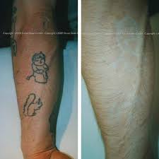 Laserbehandlung Essen Asthetische Laserbehandlung Der Haut