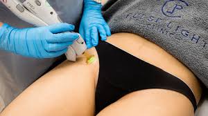 Many women choose to keep a landing strip or a little patch of hair in the area but like having hair removed from the perianal area. Bikini Laser Hair Removal Everything You Need To Know Before Trying Laser Youtube