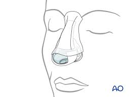 For english to tamil translation, enter the english word you want to translate to tamil meaning in the search box above and click 'search'. Closed Reduction For Nasal Bone