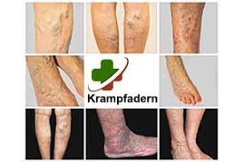 Frühzeitig erkannt, können sie gut behandelt werden. Krampfadern Symtom Ursachen Diagnose Behandlung Krank De