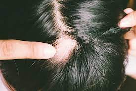 If you suffer from hair loss, some products worth checking out include women's rogaine 5% minoxidil foam for hair thinning and lossand men's rogaine 5% minoxidil foam for hair loss and hair regrowth. How To Stop Balding And Thinning And Gray Hair The Plunge