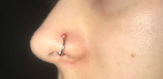 I Got My Nose Pierced Around 2 Months Ago About A Month Ago A Tiny Irritation Bump Formed Since Then It Has Gotten Bigger And A Lot More Red I M Pretty Sure