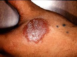 Image result for Eczema nummulare