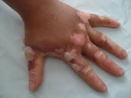 We did not find results for: Phytophotodermatitis Due To