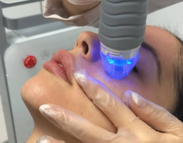 RF Fractional Microneedling | Bare Brilliance