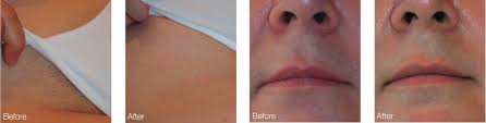 Reply laser hair removal should not cause any infections around the lip or gum areas. Laser Hair Removal For Asian Skin In Liverpool Epilight New Skin Clinic