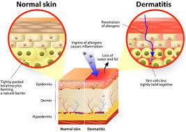 Image result for Seborrheic Dermatitis