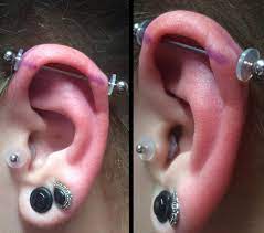 Piercing Bump 6 Ways To Get Rid Of Cartilage Or Nose Keloid Blister