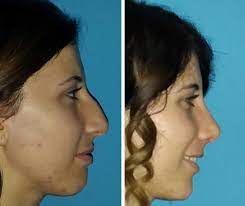 When you attend your free consultation with your patient coordinator, they will be able to show you a range of before and after photos that closely match you. Nose Job Turkey All In Nose Reshaping Package Only 1999 Medaway