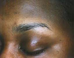 Image result for Postinflammatory Hypopigmentation