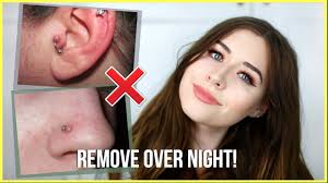 Histopathological findings confirmed the clinical suspicion that the mass was a granuloma. How To Get Rid Of Piercing Bumps Overnight Youtube