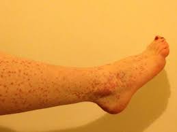 Purple spots on skin (purpura) Henoch Schonlein Purpura Hsp Infokid