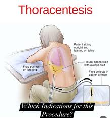 Image result for Thoracentesis
