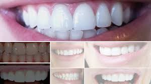 We provide expert cosmetic dentistry services for patients in and around london. Downtown Minneapolis Dentistry Cosmetic Dentist Ivory Dental Group