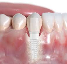 Low cost affordable dental clinics 4. Ceramic Vs Titanium Implants When To Choose Which Nobel Biocare Blog