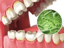 You can easily remove the plaque from your teeth at home. 4 Types Of Dental Cleanings Laurich Dentistry